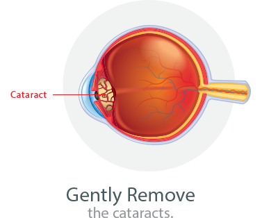 Removing Cataract