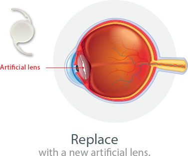 Replacing Cataract With Artificial Lens