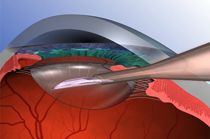 Inserting Artificial Lens