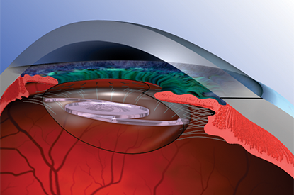 Placing Artificial Lens