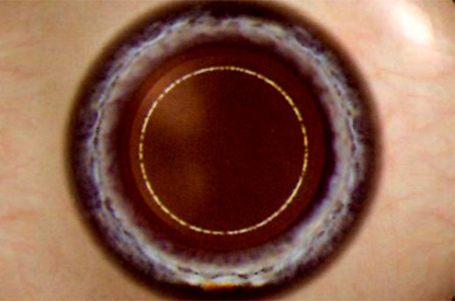 Laser Capsulorhexis