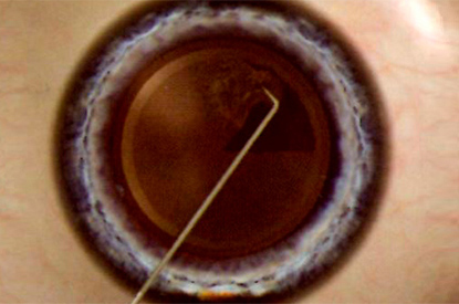 Manual Capsulorhexis